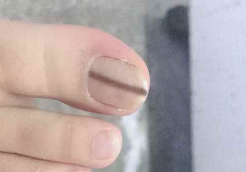 指甲有黑色竖纹是什么原因(指甲有黑色竖纹是什么原因呢)