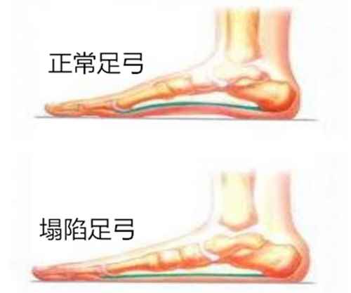 扁平足是怎么形成的(形体瘦长、肌肉无力的“体质发育不良综合征”)
